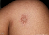 leprosy tuberculoid