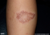 leprosy tuberculoid