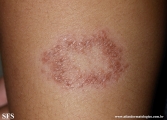 leprosy tuberculoid