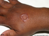 leprosy tuberculoid