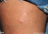 leprosy tuberculoid