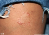 leprosy tuberculoid