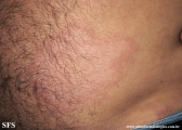 leprosy tuberculoid