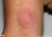 leprosy tuberculoid
