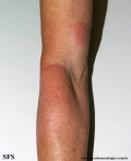 leprosy tuberculoid