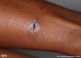 leprosy tuberculoid