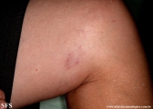 leprosy tuberculoid