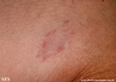 leprosy tuberculoid
