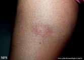 leprosy tuberculoid