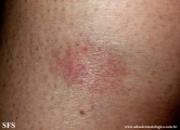 leprosy tuberculoid