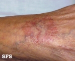 leprosy tuberculoid