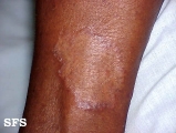 leprosy tuberculoid