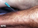 leprosy tuberculoid