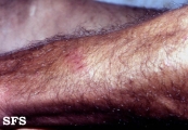 leprosy tuberculoid