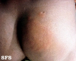 leprosy tuberculoid