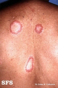 leprosy tuberculoid