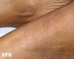 leprosy tuberculoid