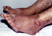 leprosy tuberculoid