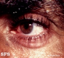 leprosy tuberculoid