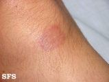 leprosy tuberculoid