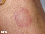 leprosy tuberculoid