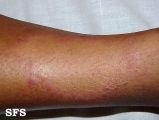 leprosy tuberculoid