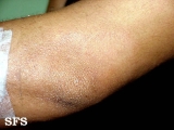 leprosy tuberculoid