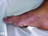 leprosy tuberculoid