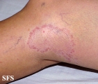 leprosy tuberculoid