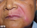 leprosy tuberculoid