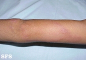 leprosy tuberculoid
