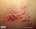leprosy tuberculoid