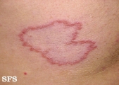 leprosy tuberculoid