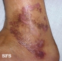leprosy tuberculoid