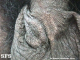 leprosy tuberculoid