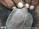leprosy tuberculoid