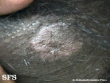 leprosy tuberculoid