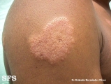 leprosy tuberculoid