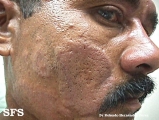 leprosy tuberculoid