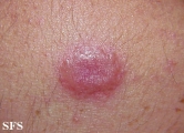 leprosy tuberculoid