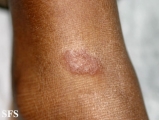 leprosy tuberculoid