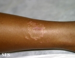 leprosy tuberculoid