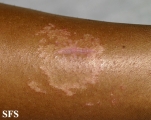 leprosy tuberculoid