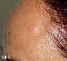 leprosy tuberculoid