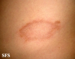 leprosy tuberculoid