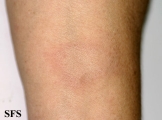 leprosy tuberculoid