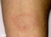 leprosy tuberculoid