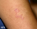 leprosy tuberculoid