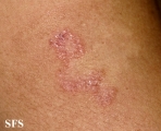 leprosy tuberculoid