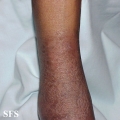 leprosy tuberculoid